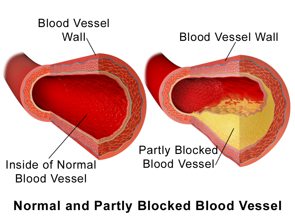 arteriosklerose