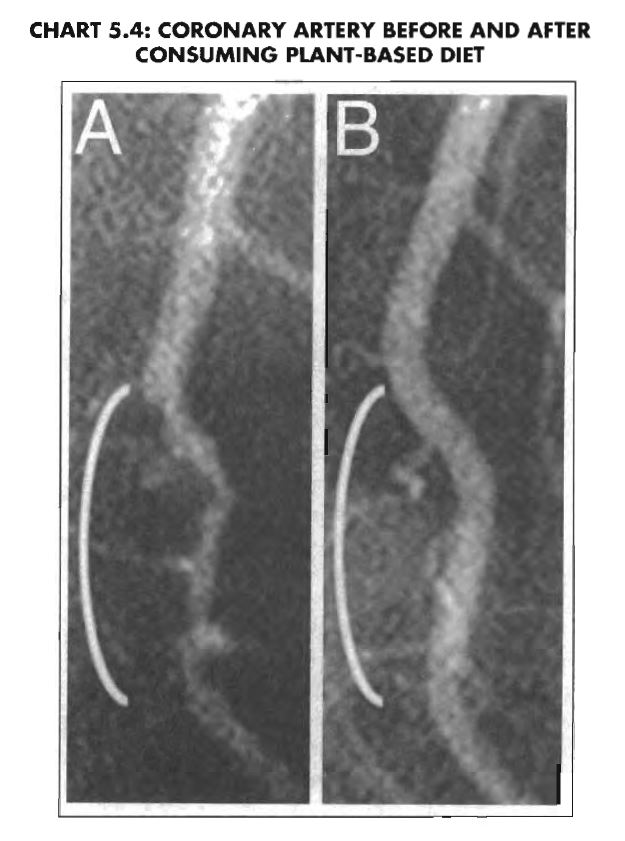 esselstyn arterie